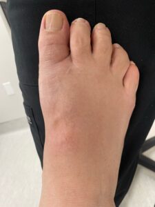 After Surgery