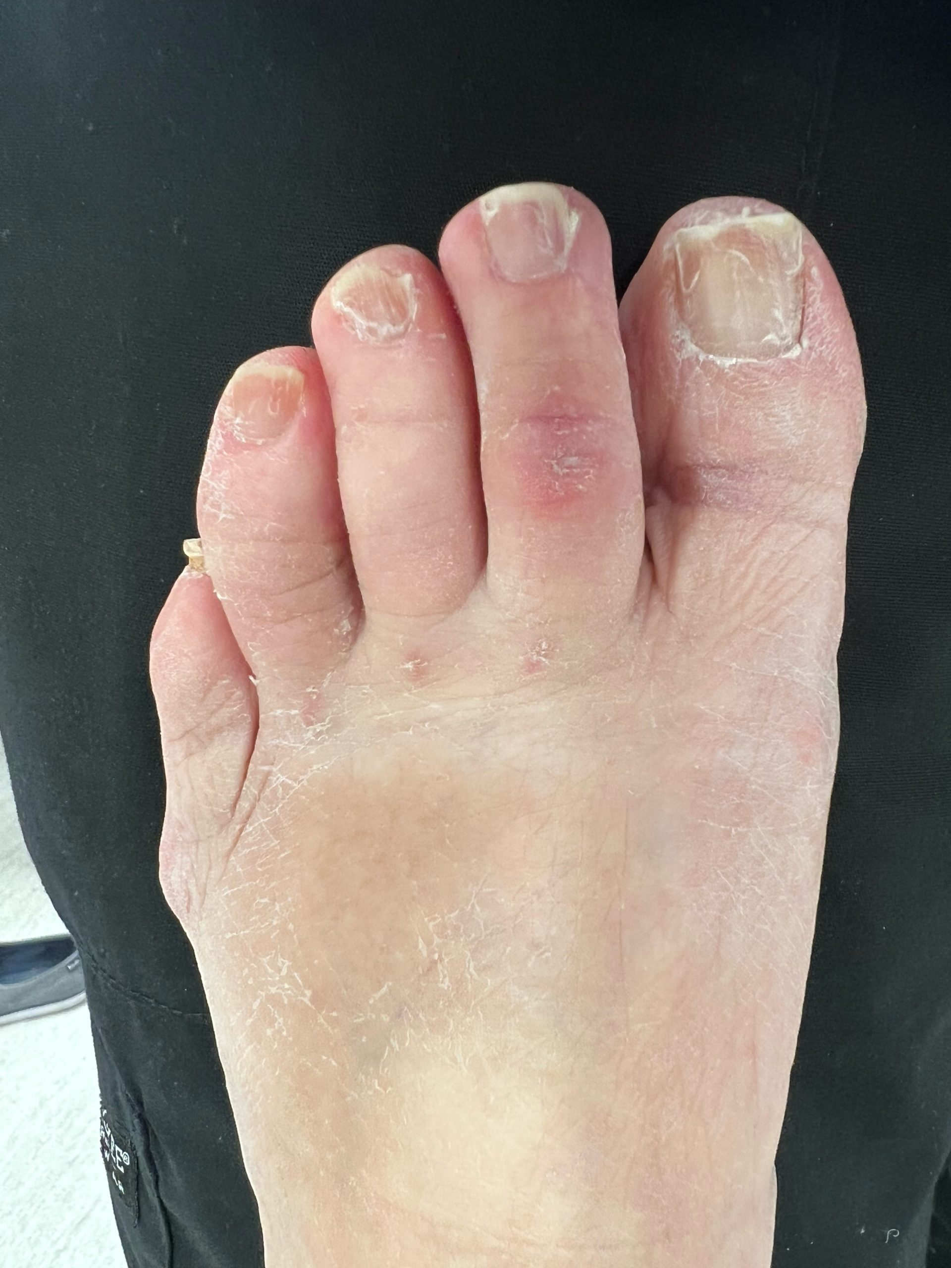 Procedure - hammertoe correction