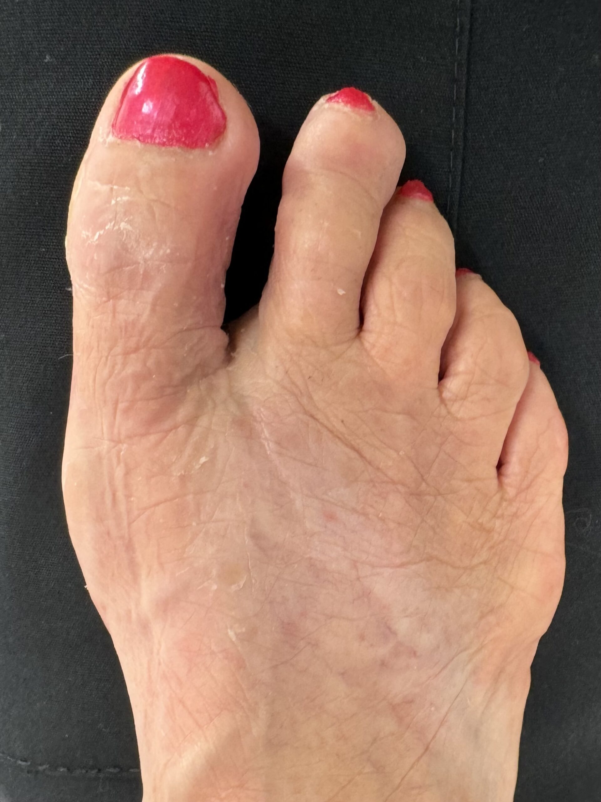 After Surgery