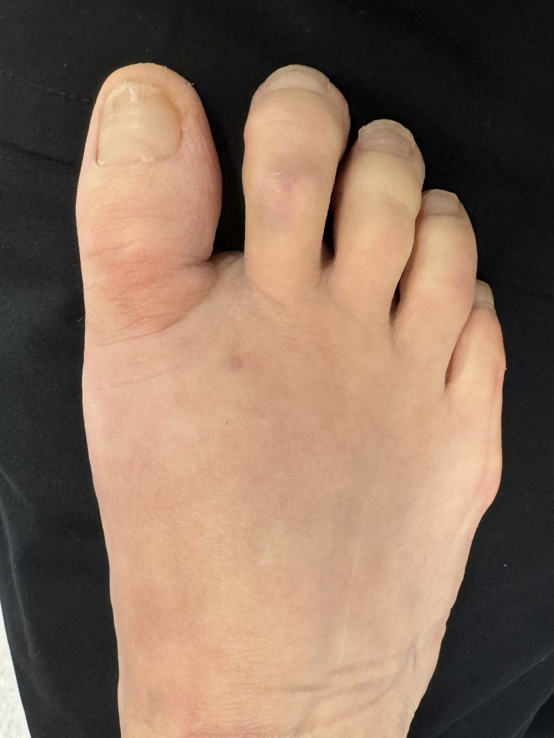 After Surgery