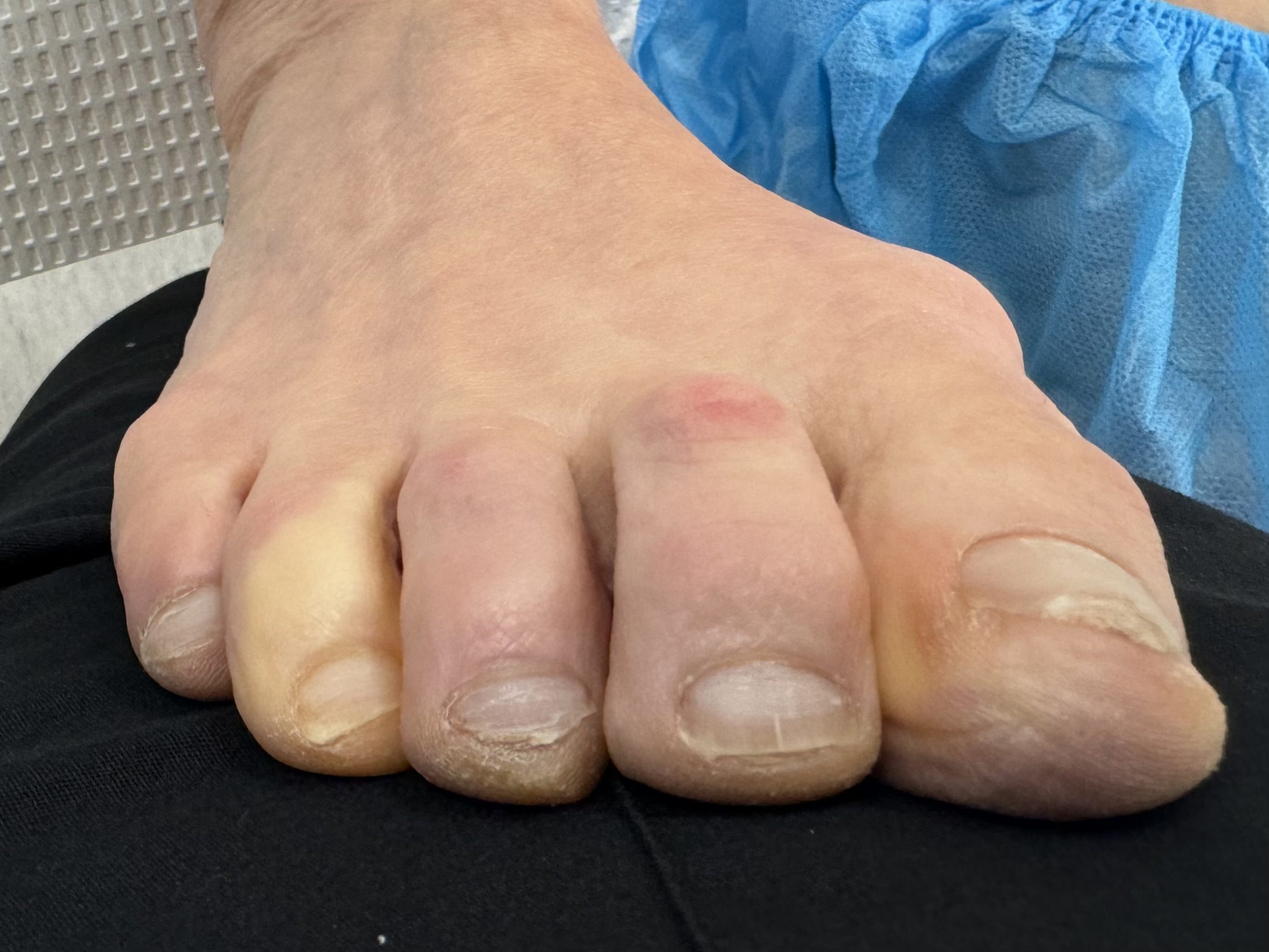 Before Surgery