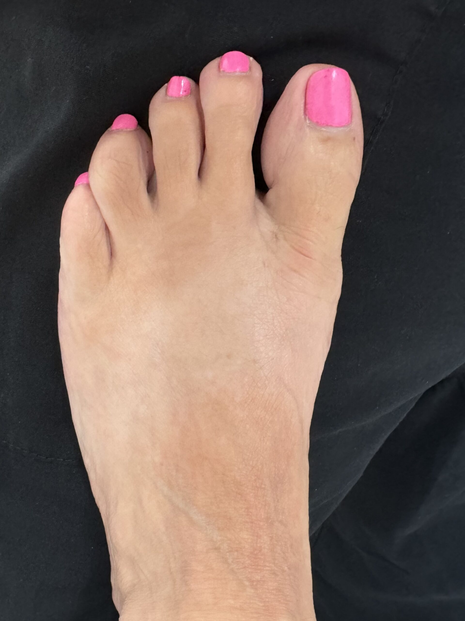 After Surgery