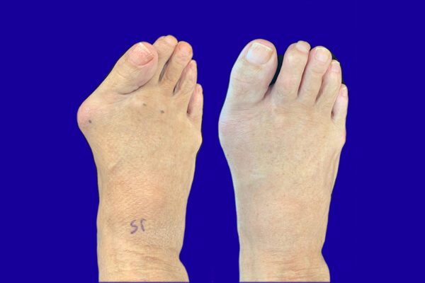 What to Expect After Bunion Surgery | Northwest Surgery Center