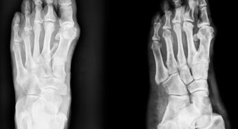 Why Traditional Bunion Surgery Should be Avoided