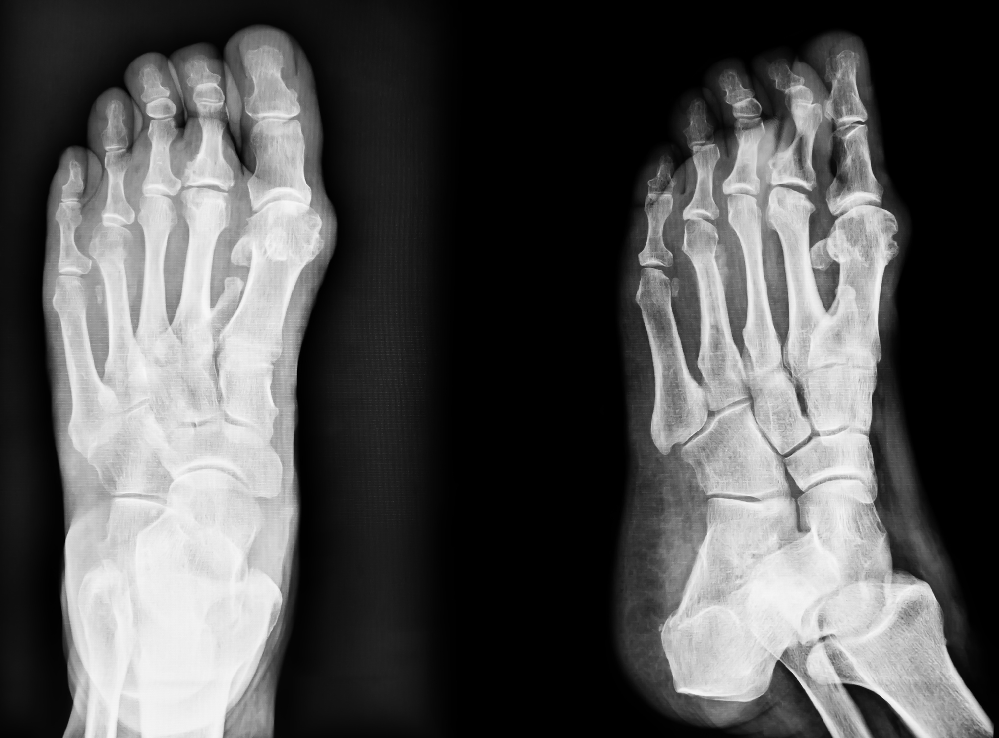 x-ray of hammertoe